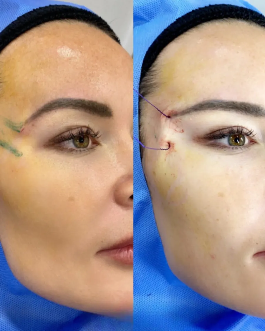 Advanced Non-Surgical Facelift with Thread Lift at Cinch Clinics